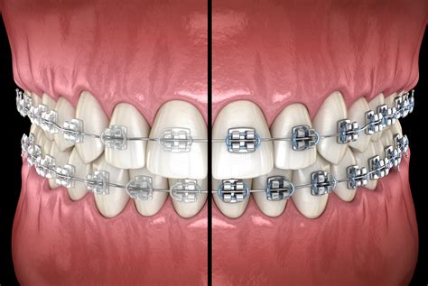 are ceramic brackets bigger than metal|ceramic braces vs metal.